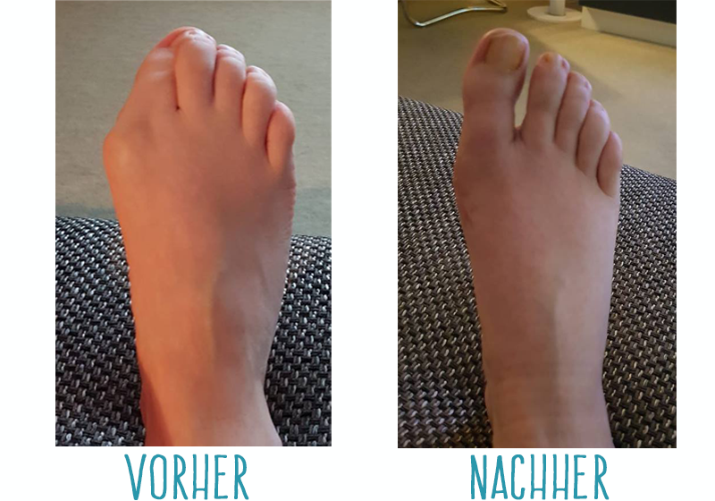 Hallux valgus Was ist das? Was kann man dagegen tun? • breitefuesse.de